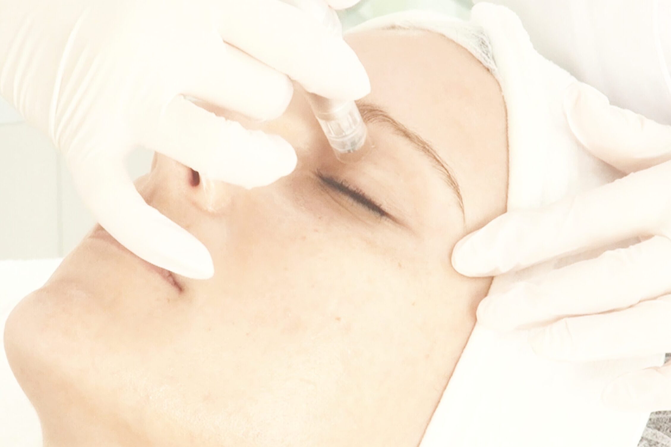 Micro Needling Behandlung in Andernach bei Kosmetikinstitut Day Spa in Eich